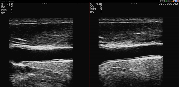 Vascular Ultrasound