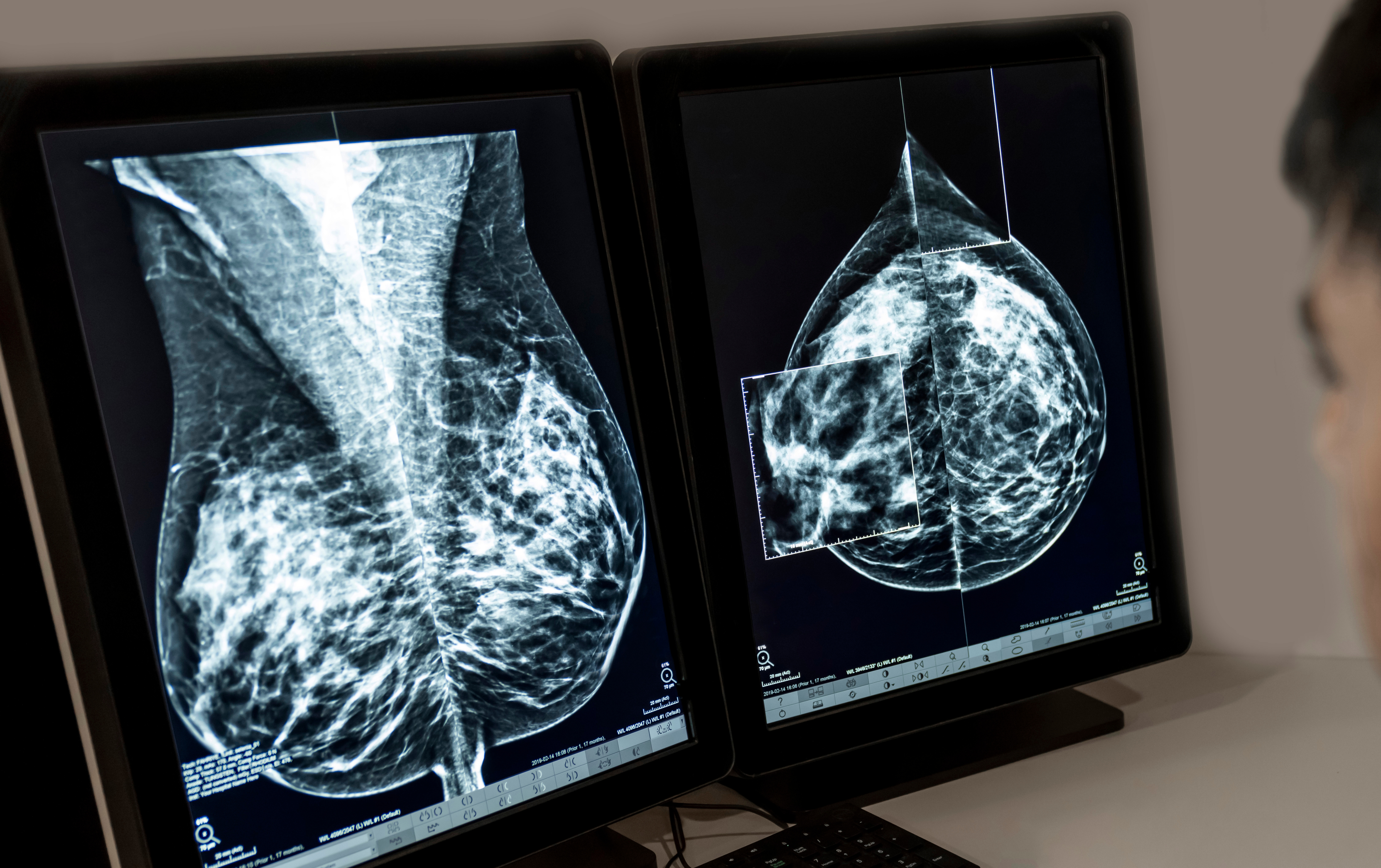 Radiologist reviewing mammography images on dual monitors within a mammography PACS workstation