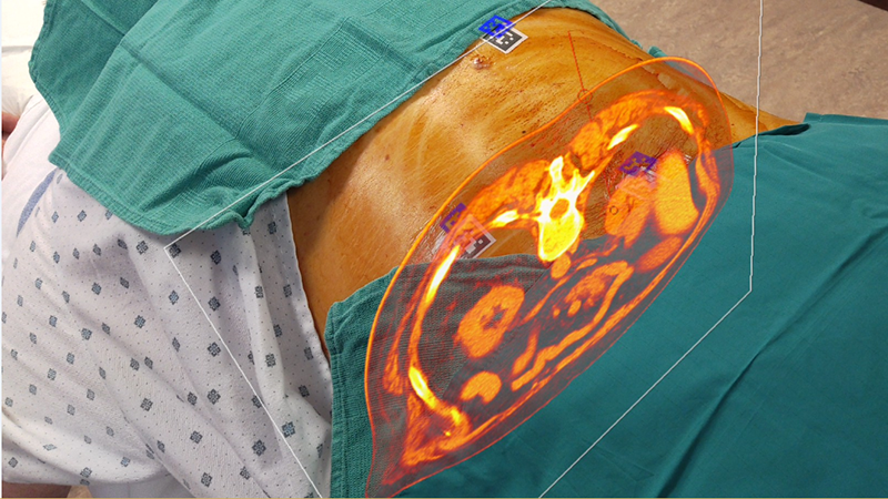 Spine Live Back Surgery Spine Live Back Surgery